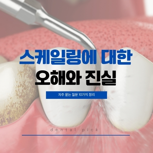 스케일링 시술 중 치아에 초음파 기구를 적용하는 장면과 스케일링에 대한 오해와 진실 텍스트가 담긴 치과 정보 이미지