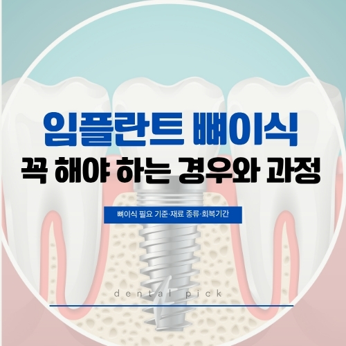 임플란트 뼈이식 — 꼭 해야 하는 경우와 과정 | 뼈이식 필요 기준, 재료 종류, 회복기간 안내 이미지