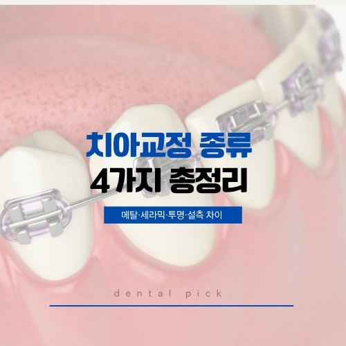 치아교정 종류 4가지 비교 – 메탈·세라믹·투명·설측 교정 차이점 인포그래픽