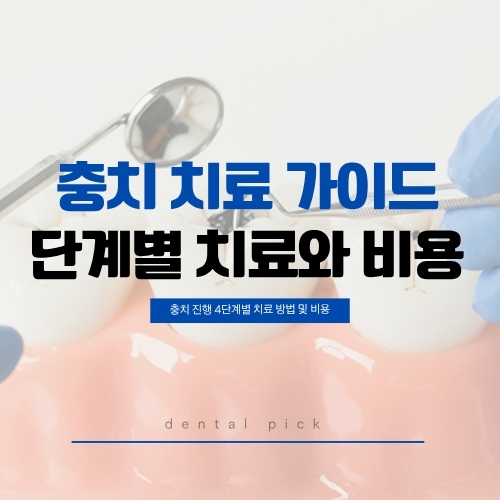 충치 치료 가이드 — 단계별 치료와 비용 | 충치 진행 4단계별 치료 방법 및 비용 안내 이미지